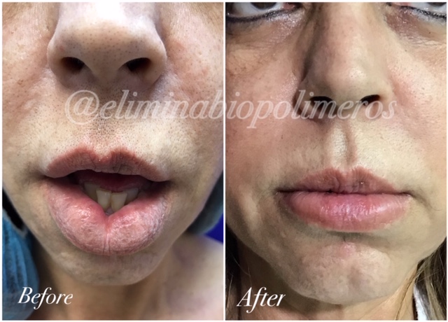 silicone injection removal lips